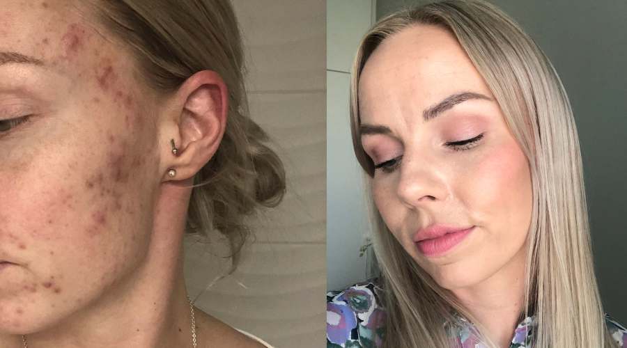 Aikuisiän akne - tarina miten pääsin eroon aknesta