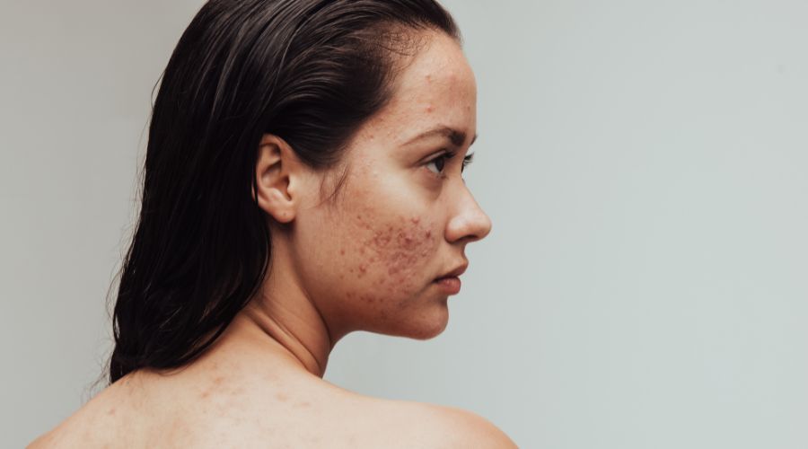 Akne - kaikki mitä sinun tulisi tietää