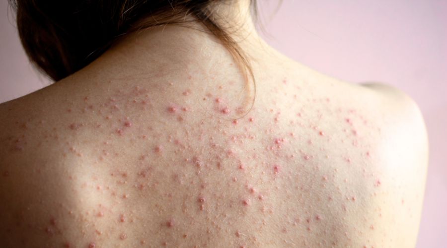 Akne selässä - syyt ja tuloksekas hoito