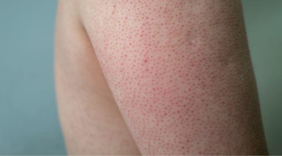 Mikä on keratosis pilaris ja miten sitä hoidetaan?