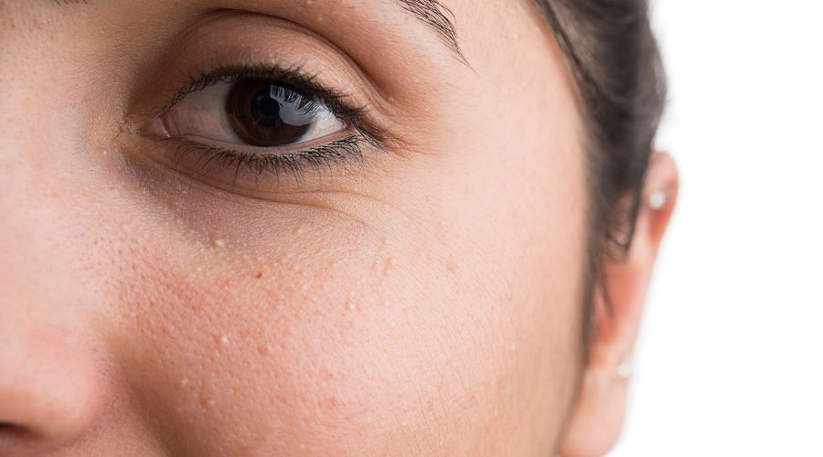 Luufinni – poisto, syyt ja ennaltaehkäisy