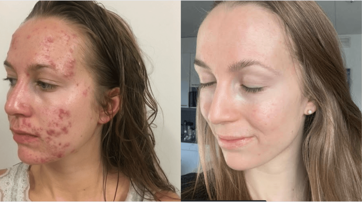 Miten Anniina sai tuloksia akneihon hoidossa?