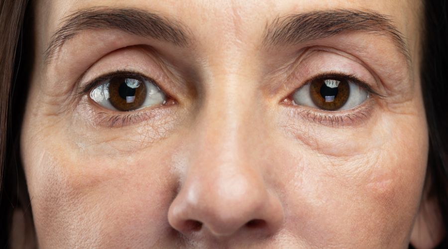 Silmäpussit pois - kokeile näitä ihonhoidon asiantuntijan vinkkejä!