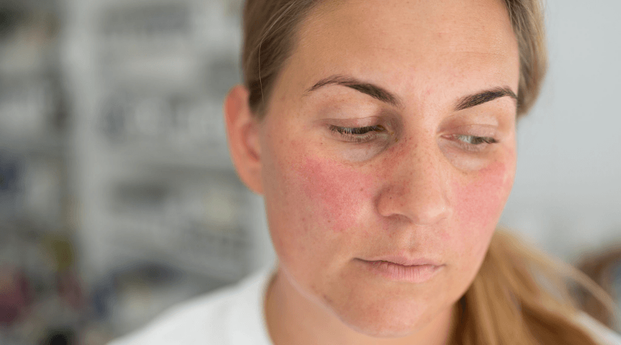 Couperosa - näin hoidat oikeaoppisesti