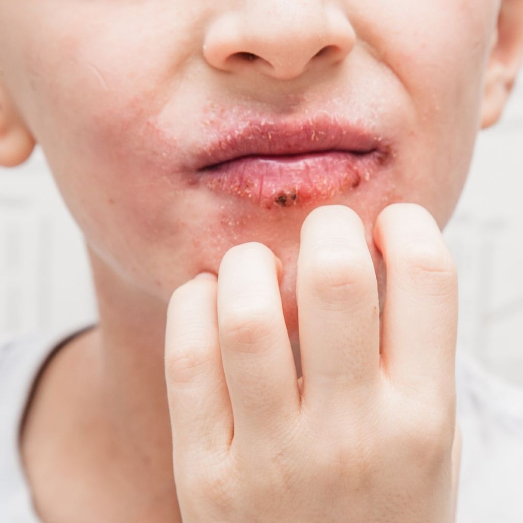 Atooppisen ihon setit