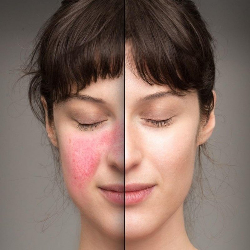 Lisäravinteet tulehduksellisen iho-ongelman hoitoon - Twistbe 