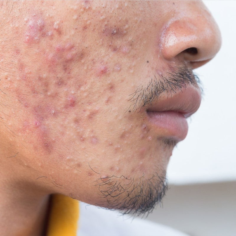 Kasvoöljy akneiholle