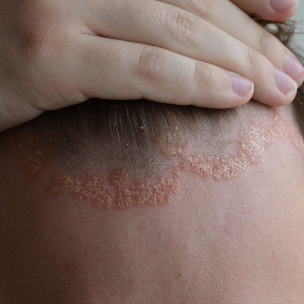 Psoriasis: Seerumit