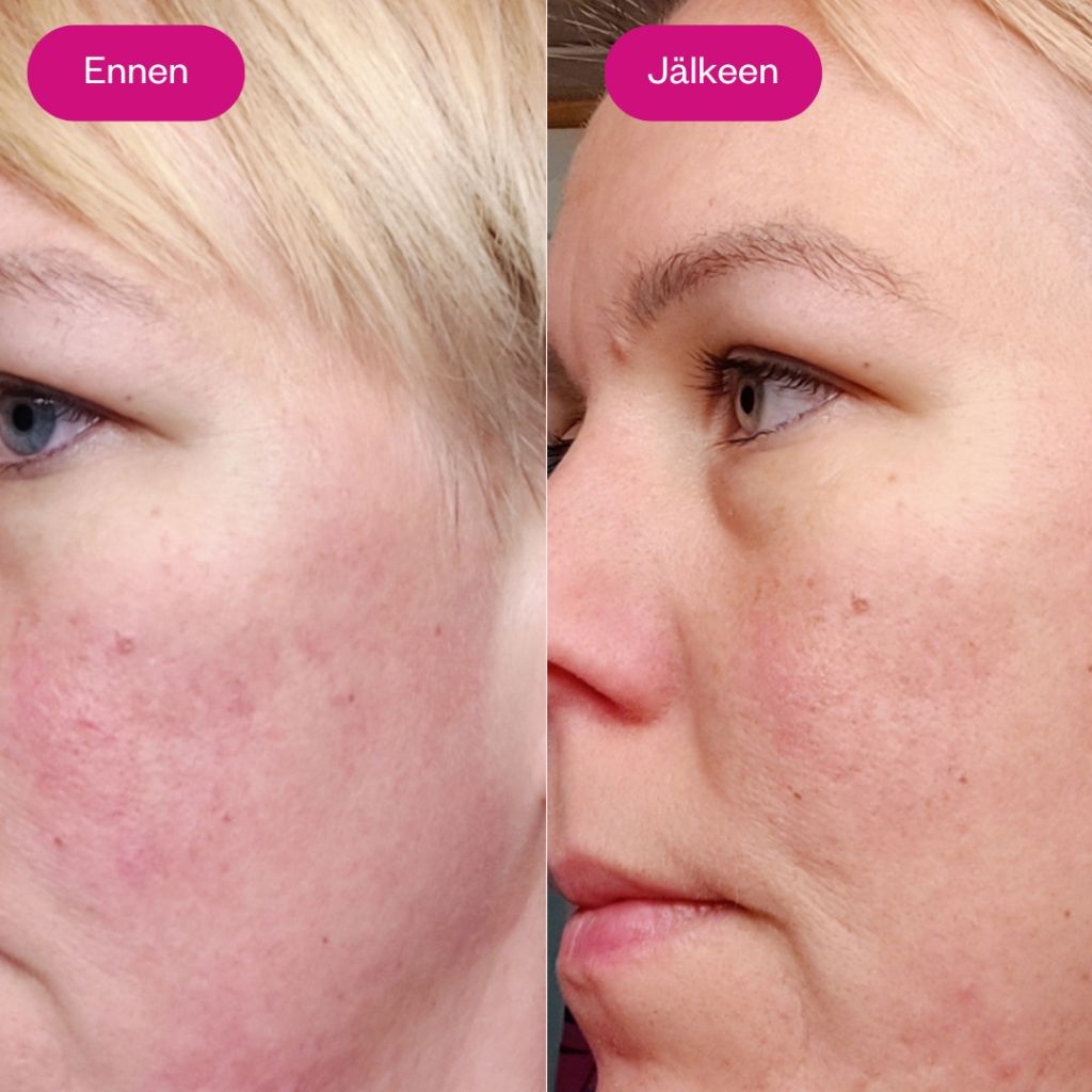 Flow Cosmetics AHA BHA kokemuksia, ennen jälkeen kuva