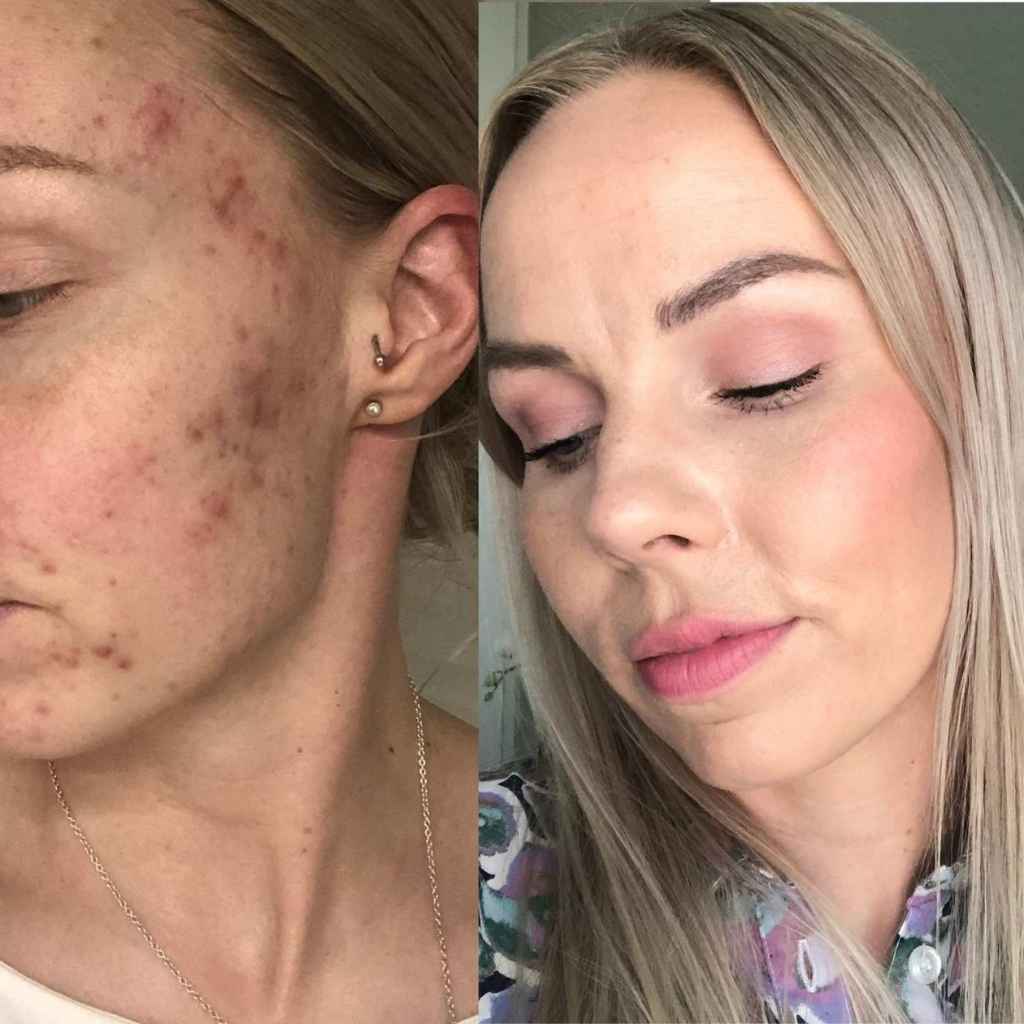 Hormonaalinen akne hoito kokemuksia