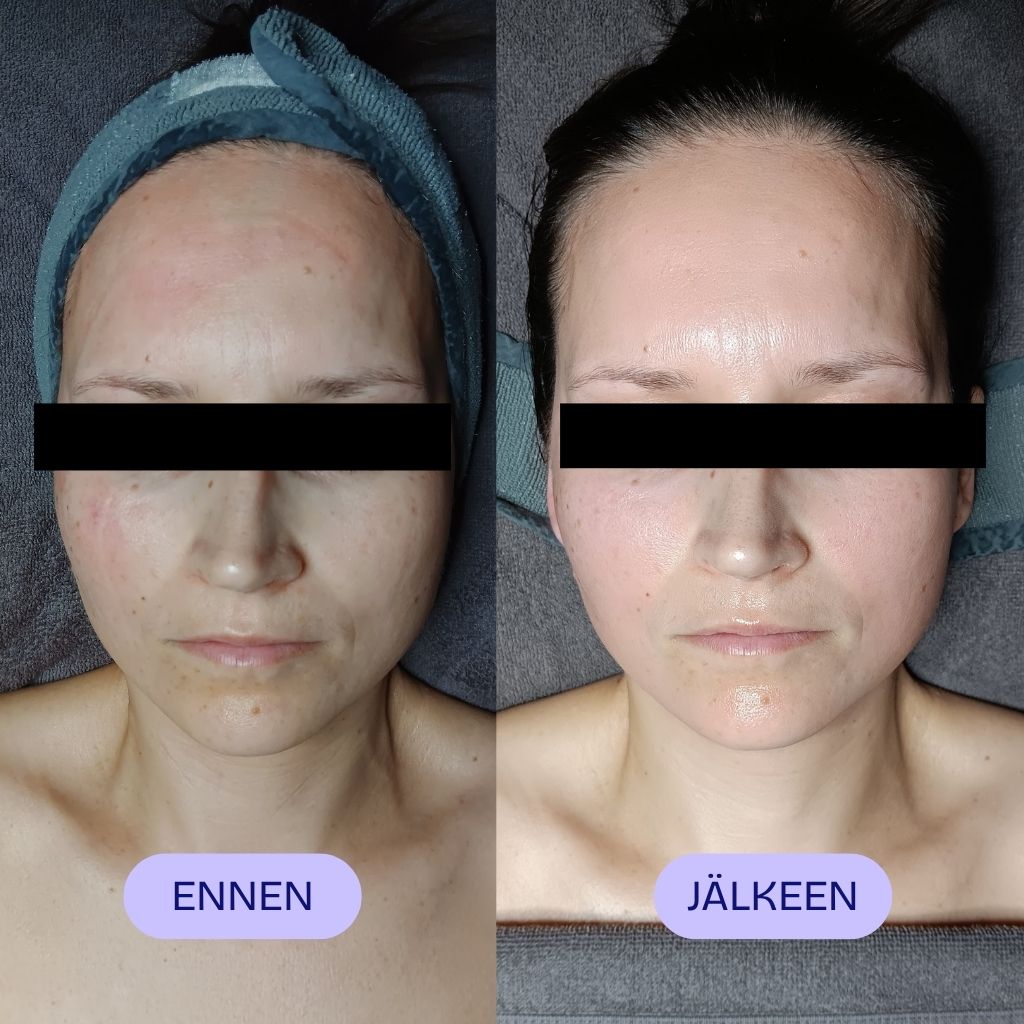 Lymfahieronta kasvoille ennen ja jälkeen hoidon