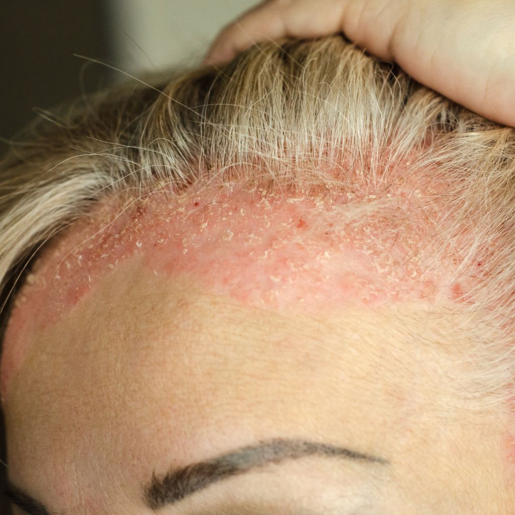 Seborrooinen ekseema hoito ja asiantuntijan tuotesuositukset