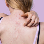 Selkä akne hoito 45min