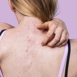 Selkä akne hoito 45min