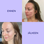 Twistbe jojoba teepuu kasvooljy ennen ja jälkeen käytön