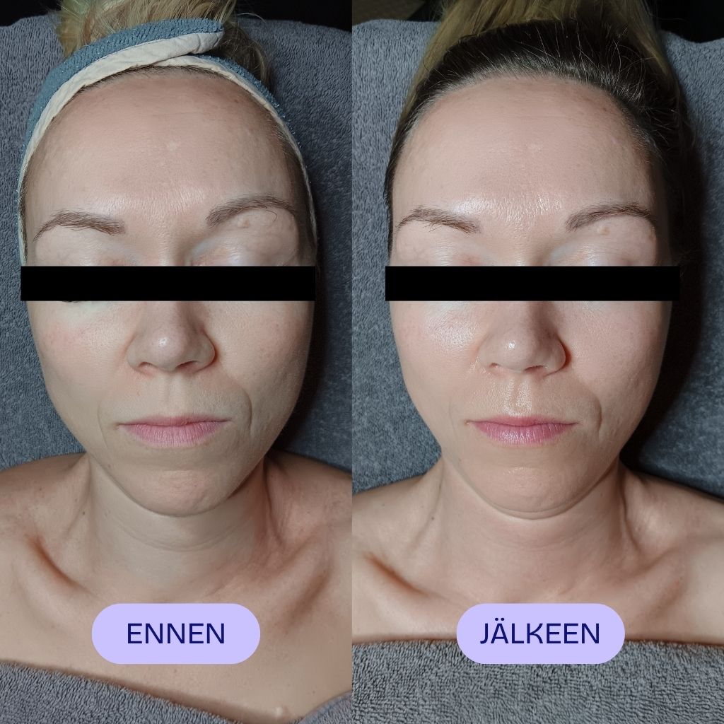 Yin Your Skin® Pro Gua Sha kasvohoito ennen ja jälkeen hoidon
