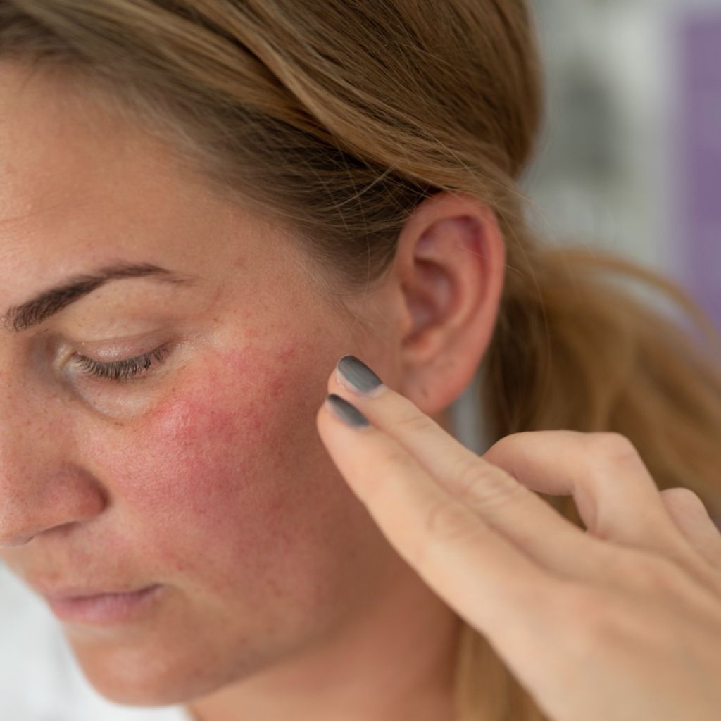 Couperosa ihon hoito ja parhaat tuotteet couperosa iholle!