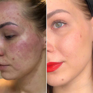Twistbe asiakas ennen ja jälkeen: atooppinen iho